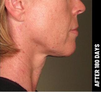 Ultherapy Before & After Patient #1557